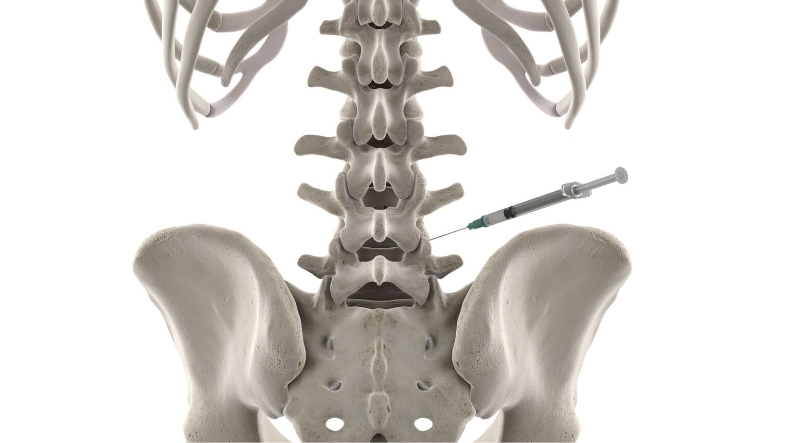 Facet Joint Injections – spinecare.uk