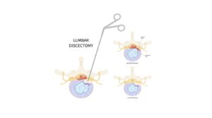 Lumbar Microdiscectomy Treatment | Spine Care UK