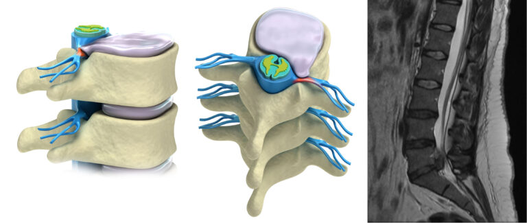 Lumbar Microdiscectomy Treatment | Spine Care UK