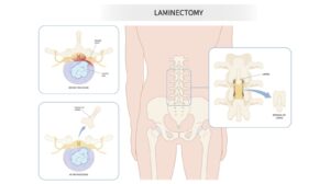 Lumbar Laminectomy Surgery UK | Spine Care UK