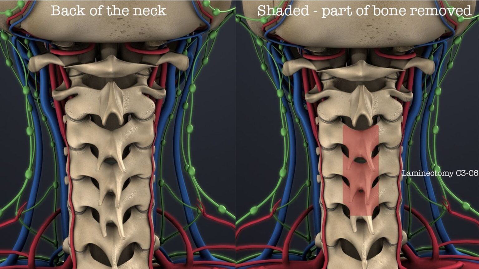 Cervical Laminectomy Surgery | Spine Care UK