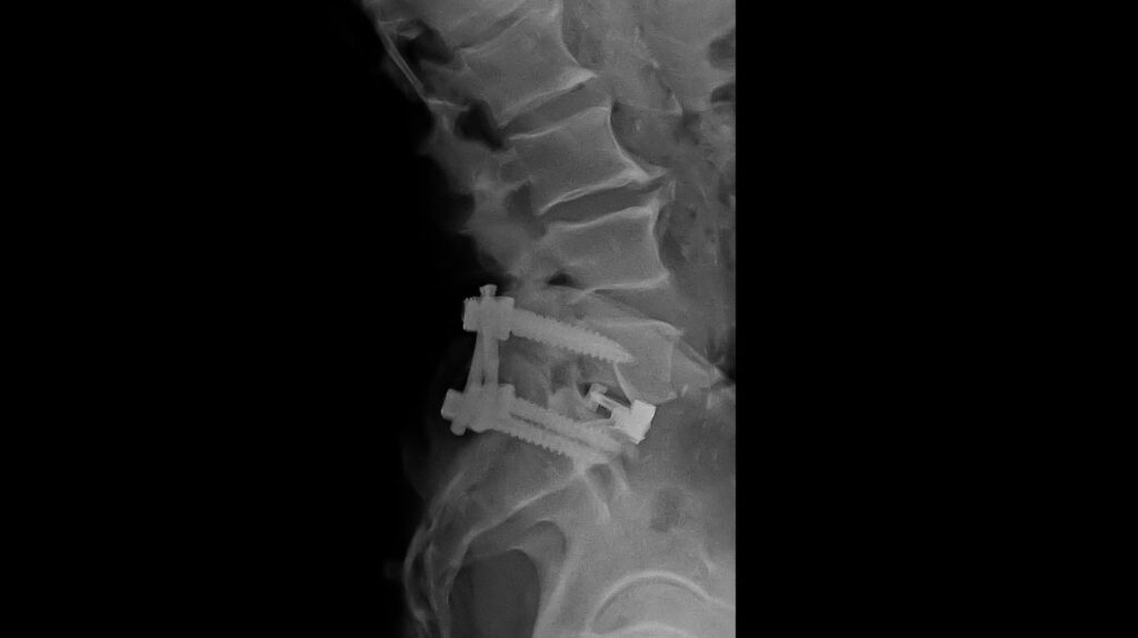 ALIF Surgery (Anterior Lumbar Interbody Fusion)