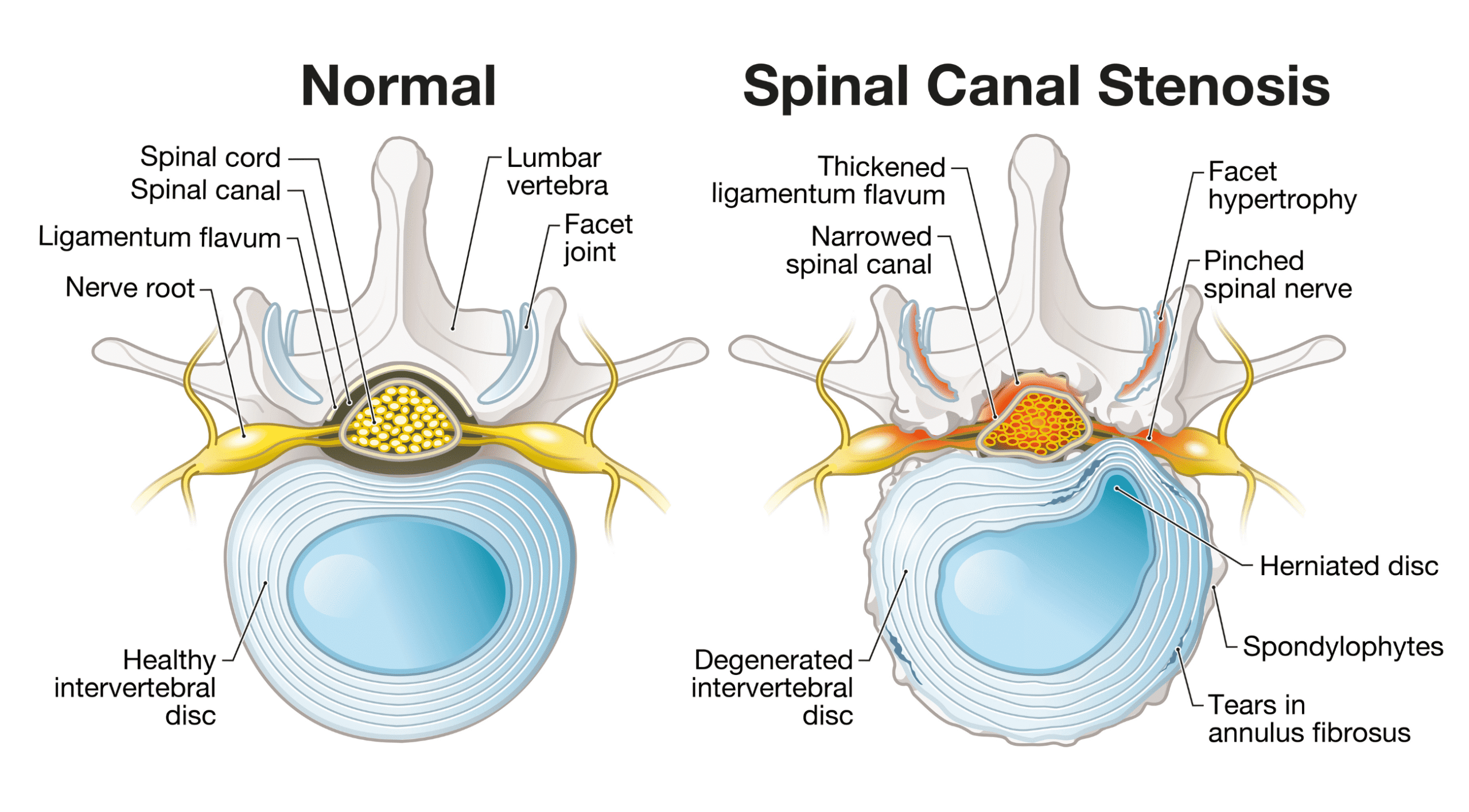 Lumbar Spinal Stenosis: Is Surgery Right for You?