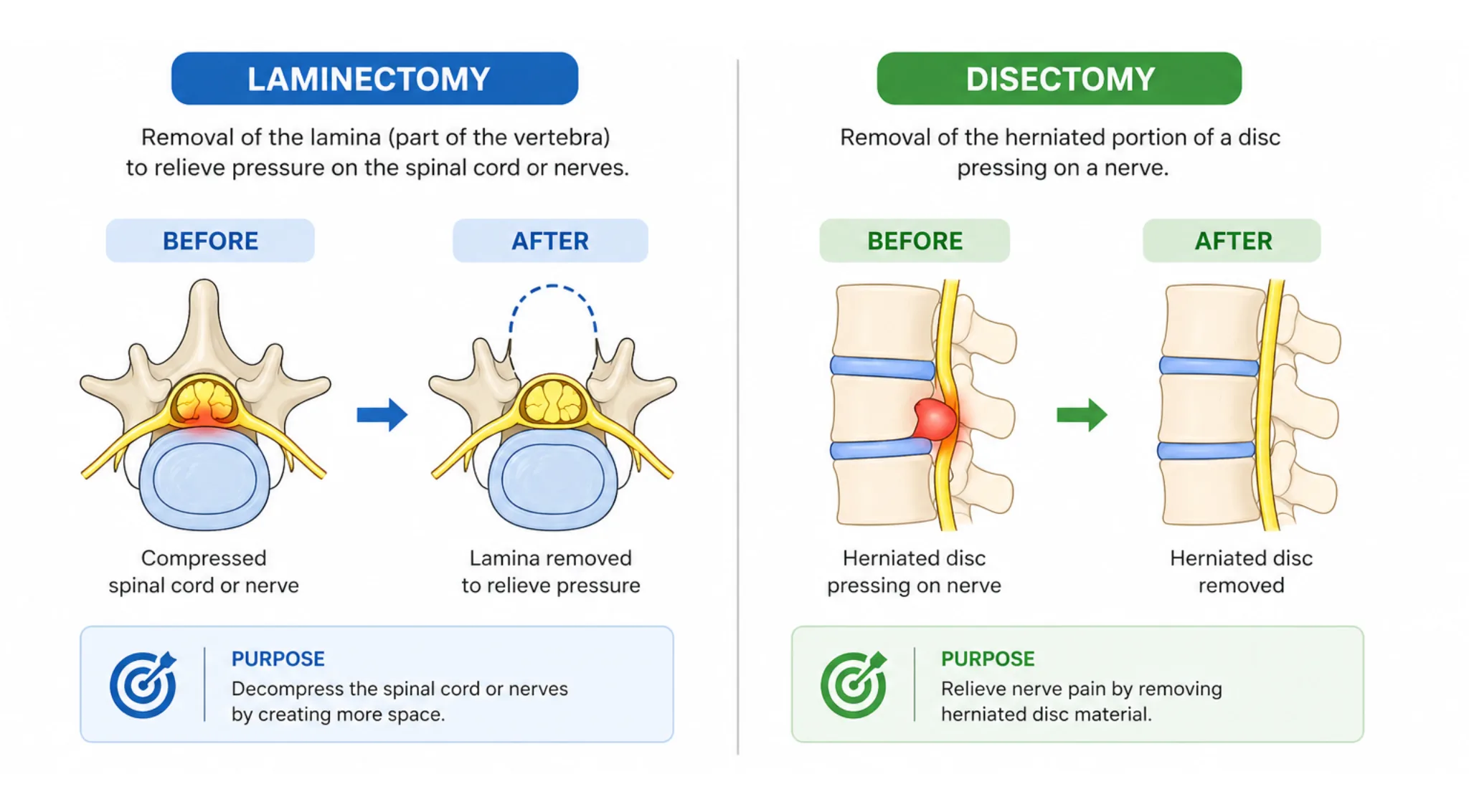 Laminectomy vs Discectomy What's the Difference