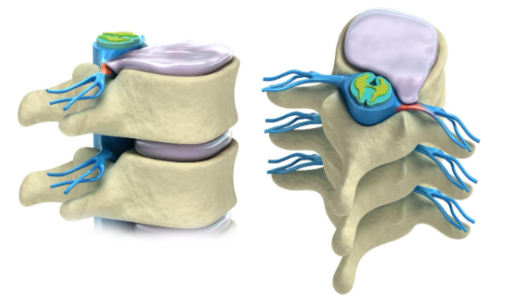 Slipped Disc: Do I Need to Worry?